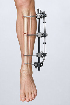 Lower leg fracture stabilized with external fixator