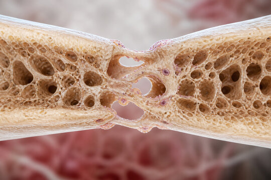 Healing bone trabeculae bridging a repaired fracture gap