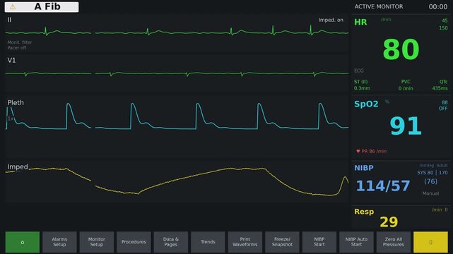 Animated EKG heart rate monitor displaying a rhythm that exhibits atrial fibrillation (AFib)