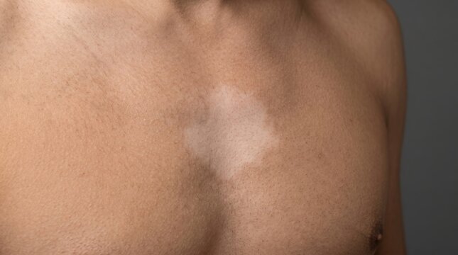 Vitiligo White Patch Spot on Male Chest Skin Close Up