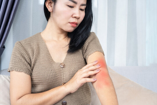 Asian woman scratching red itchy skin rash on her arm. Ideal for skin allergy, eczema, dermatitis, insect bite, sensitive skin treatment, and dermatology healthcare concept