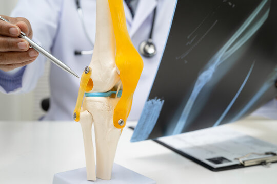 Doctor examining knee joint bone radiography xray film.
