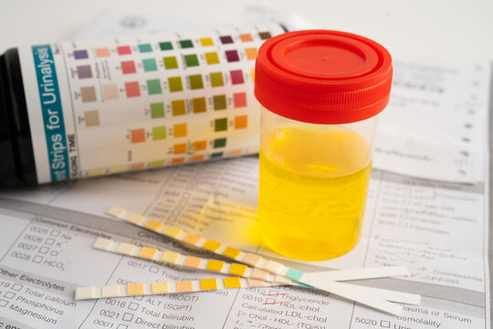 Urinalysis, urine cup with reagent strip pH paper test and comparison chart in laboratory.