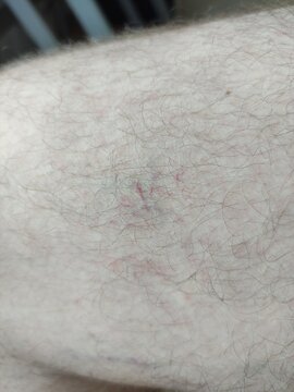 Varicose veins and purple dilated capillaries on hairy leg skin close up
