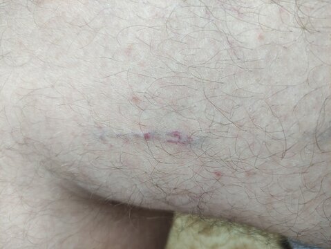 Purple spider veins and varicose veins on pale hairy skin of a leg