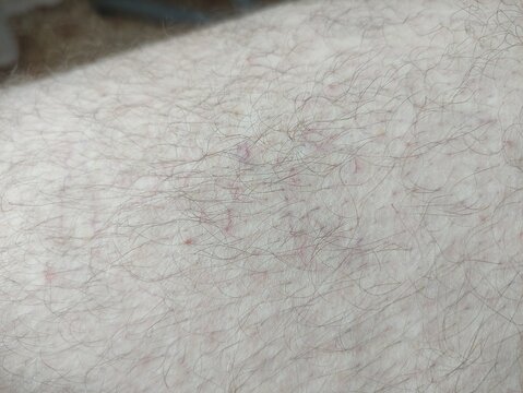 Close up of varicose veins and small red spider veins on hairy pale leg skin