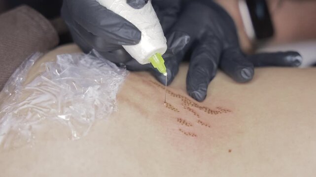 Cosmetic plasma pen treatment on abdominal skin for tightening and rejuvenation procedure, Close-up of aesthetic skin therapy creating precise treatment dots.