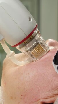 A multifunctional device for microneedle RF lifting. Aesthetic procedures for non-surgical lifting, smoothing fine lines, minimizing pores, regulating sebum production, and evening out skin texture.