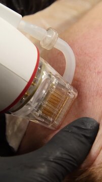 A multifunctional device for microneedle RF lifting. Aesthetic procedures for non-surgical lifting, smoothing fine lines, minimizing pores, regulating sebum production, and evening out skin texture.