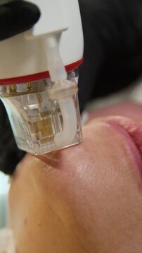 A multifunctional device for microneedle RF lifting. Aesthetic procedures for non-surgical lifting, smoothing fine lines, minimizing pores, regulating sebum production, and evening out skin texture.