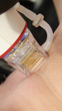 A multifunctional device for microneedle RF lifting. Aesthetic procedures for non-surgical lifting, smoothing fine lines, minimizing pores, regulating sebum production, and evening out skin texture.