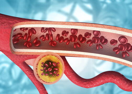 Three-dimensional illustration of a blood vessel narrowed by yellow cholesterol plaque, demonstrating arterial blockage and atherosclerosis