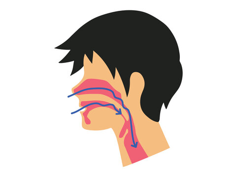 Snoring and Partial Obstruction of the Airway during Sleep
