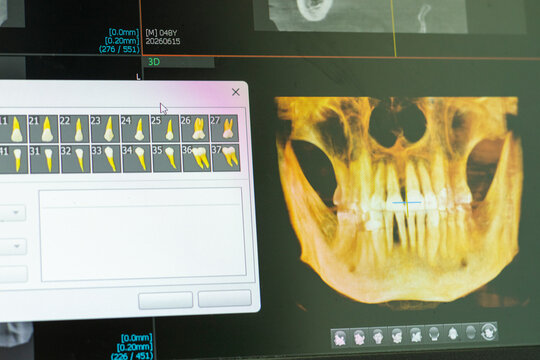 Computer Screen Showing 3D Dental CBCT Software with Volumetric Skull Rendering and Tooth Selection. Dental