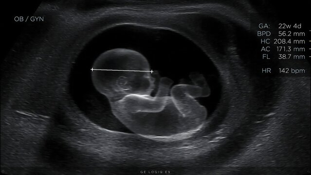 Ultrasound image showing fetal head measurement at 22 weeks