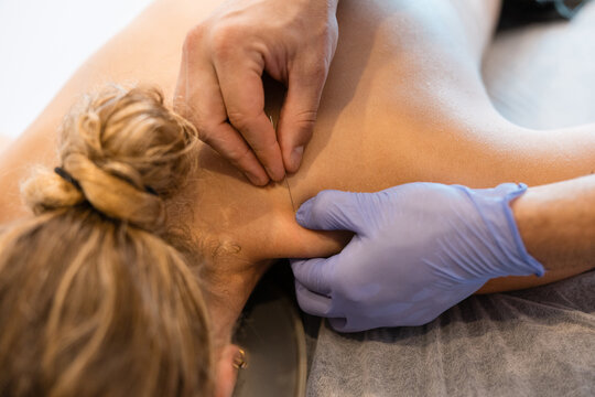 Therapist performing dry needling on patient's back