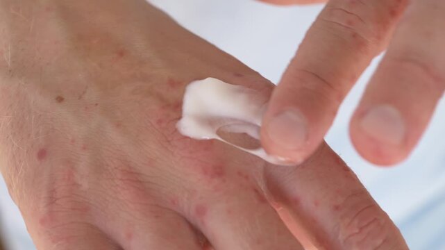 Man applies white cream to irritated skin on hand with red rash spots. Topical treatment, moisturizer application and sensitive skin care concept. Topical treatment for eczema and skin allergy