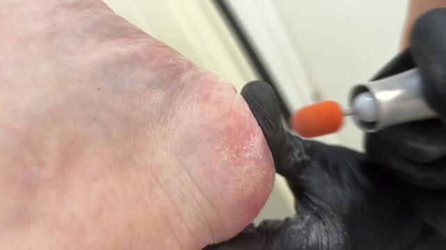 Closeup of a podiatrist cleaning dry skin on a client's heel with an electric foot care device, removing surface buildup