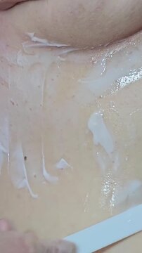Professional removal of papillomas and moles with electrocoagulation procedure in dermatology clinic. overweight European woman on the surgical table. moles papillomas neoplasms on the body