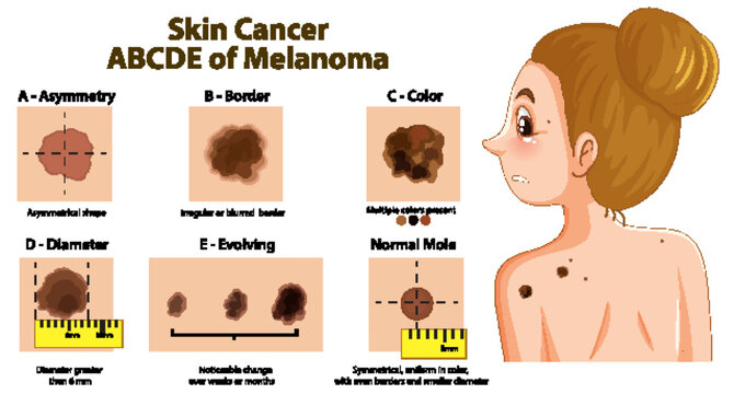 Medical Infographic Explaining the ABCDE Rule for Skin Cancer Melanoma