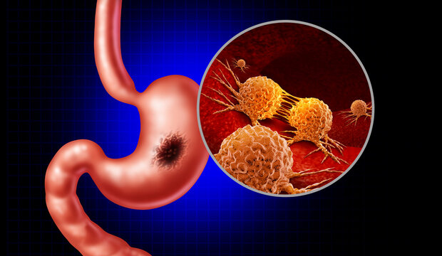 Stomach cancer and gastric tumor in the digestive system representing gastrointestinal disease stomach pain digestive symptoms cancer diagnosis and medical healthcare concepts.