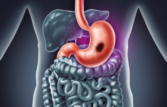 Stomach tumor and digestive cancer and gastric tumors in the digesting system representing gastrointestinal disease stomach pain digestive symptoms cancer diagnosis and medical healthcare concepts.
