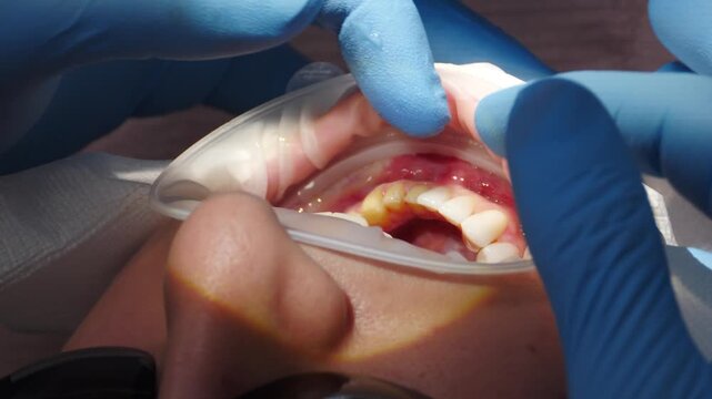 Close-up dentist gloved hands placing dental veneers and crowns on front upper teeth. Retractor holds mouth open, cosmetic restoration procedure achieving perfect smile and bite 4k video