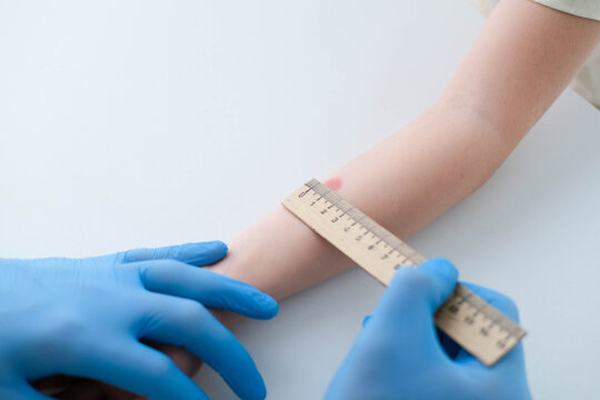 A nurse is doing an important Mantoux test on a child. The doctor measures the Mantoux test with a ruler for a little boy