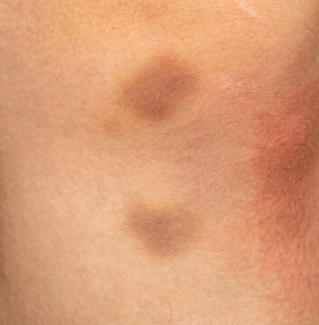 Close-up of two dark spots on human skin