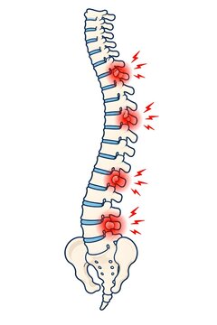  human spine with painful spinal joint