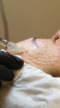 Injections of skin-lifting treatments. Mesotherapy. Close-up of female face during youth restoration and facial rejuvenation procedure.