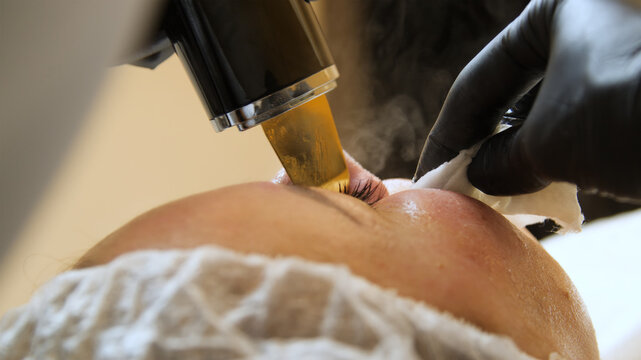 Injections of skin-lifting treatments. Mesotherapy. Close-up of female face during youth restoration and facial rejuvenation procedure.