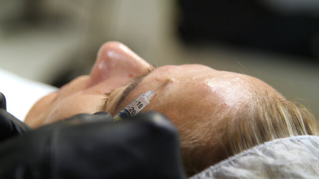 Injections of skin-lifting treatments. Mesotherapy. Close-up of female face during youth restoration and facial rejuvenation procedure.