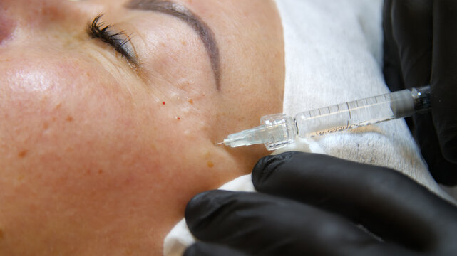 Kyiv, Ukraine - August 17, 2026: Injections of skin-lifting treatments. Mesotherapy. Close-up of female face during youth restoration and facial rejuvenation procedure.