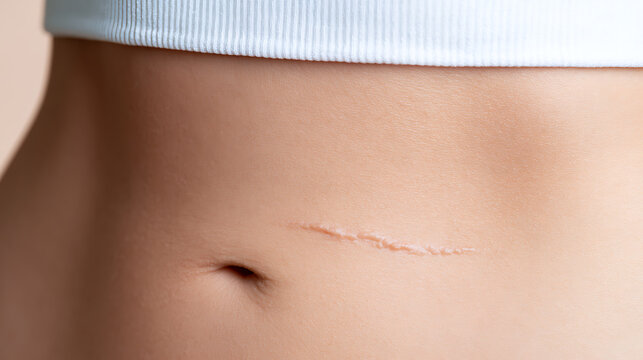 Close-up view of a noticeable abdominal scar on smooth human skin near the belly button, highlighting body acceptance and health care