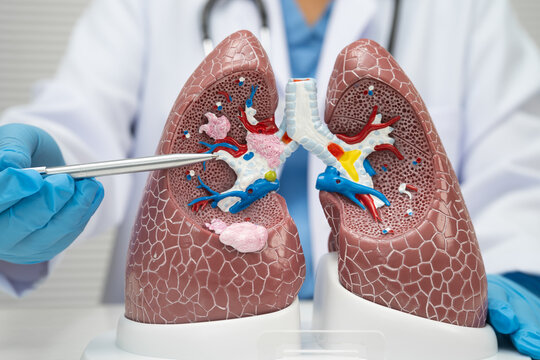 Pneumonia, lung cancer, Asian doctor with human lung model.