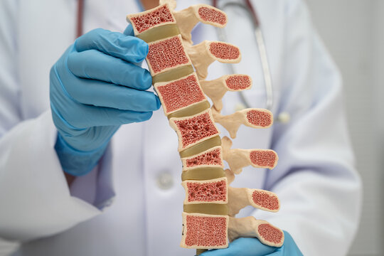 Doctor holding osteoporosis in back bone model.