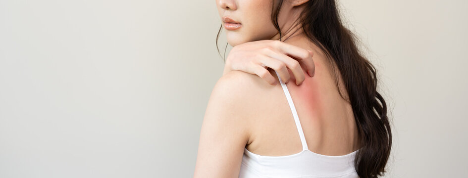 Dermatology, asian young woman reaction from atopic, insect bites on her back, hand in scratching itchy red spot or rash of skin. Healthcare, treatment of beauty.