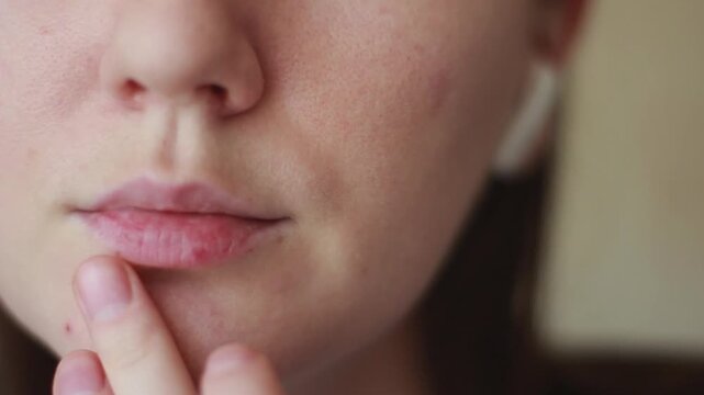Close up of young woman touching dry chapped lips with finger
