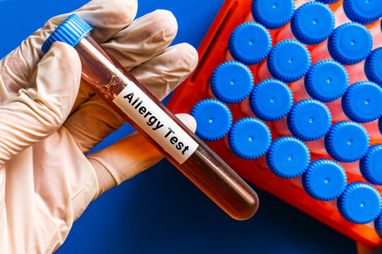 blood sample in lab tube for Allergy test