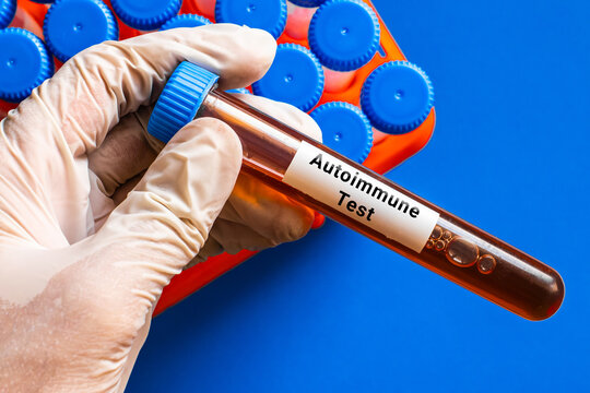 blood sample in lab tube for Autoimmune test