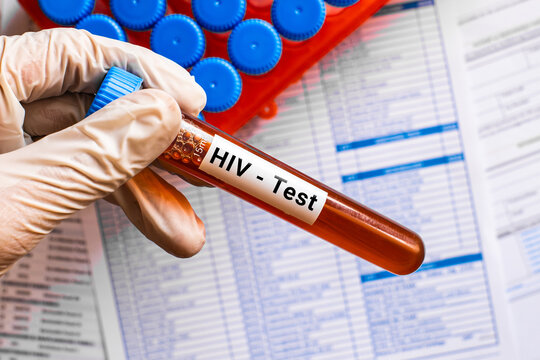 blood sample in lab tube for HIV test