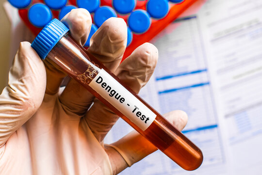 blood sample in lab tube for Dengue test
