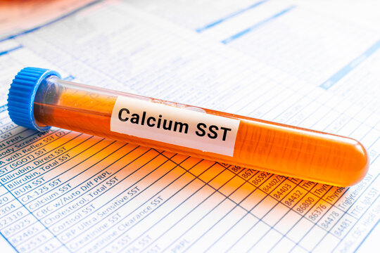 blood sample in lab test tube for Calcium SST