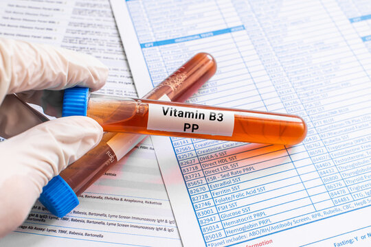 blood sample in lab test tube for Vitamin B3 PP