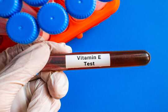 blood sample in lab test tube for Vitamin E