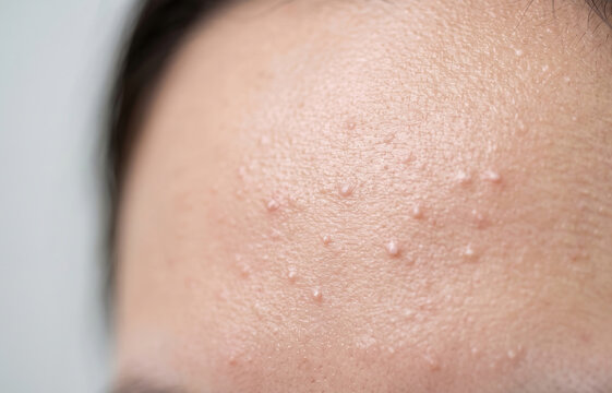 Dense closed comedones and pityrosporum folliculitis fungal acne bumps on forehead skin surface