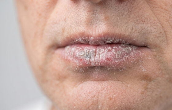 Chronic actinic cheilitis on lower lip with leukoplakia precancerous plaques and superficial ulceration