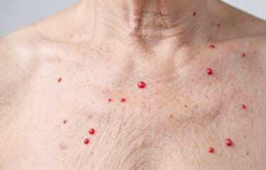 Naklejka premium Multiple Cherry Angiomas Red Moles on Senior Woman Chest Skin