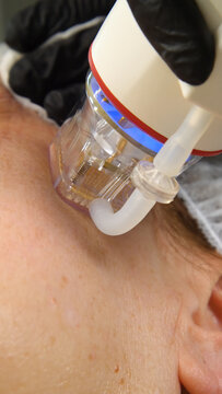 A multifunctional device for microneedle RF lifting. Aesthetic procedures for non-surgical lifting, smoothing fine lines, minimizing pores, regulating sebum production, and evening out skin texture.